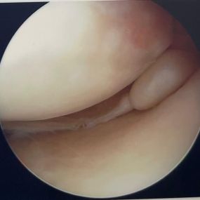 Cirugia Artroscopia de rodilla y hombro